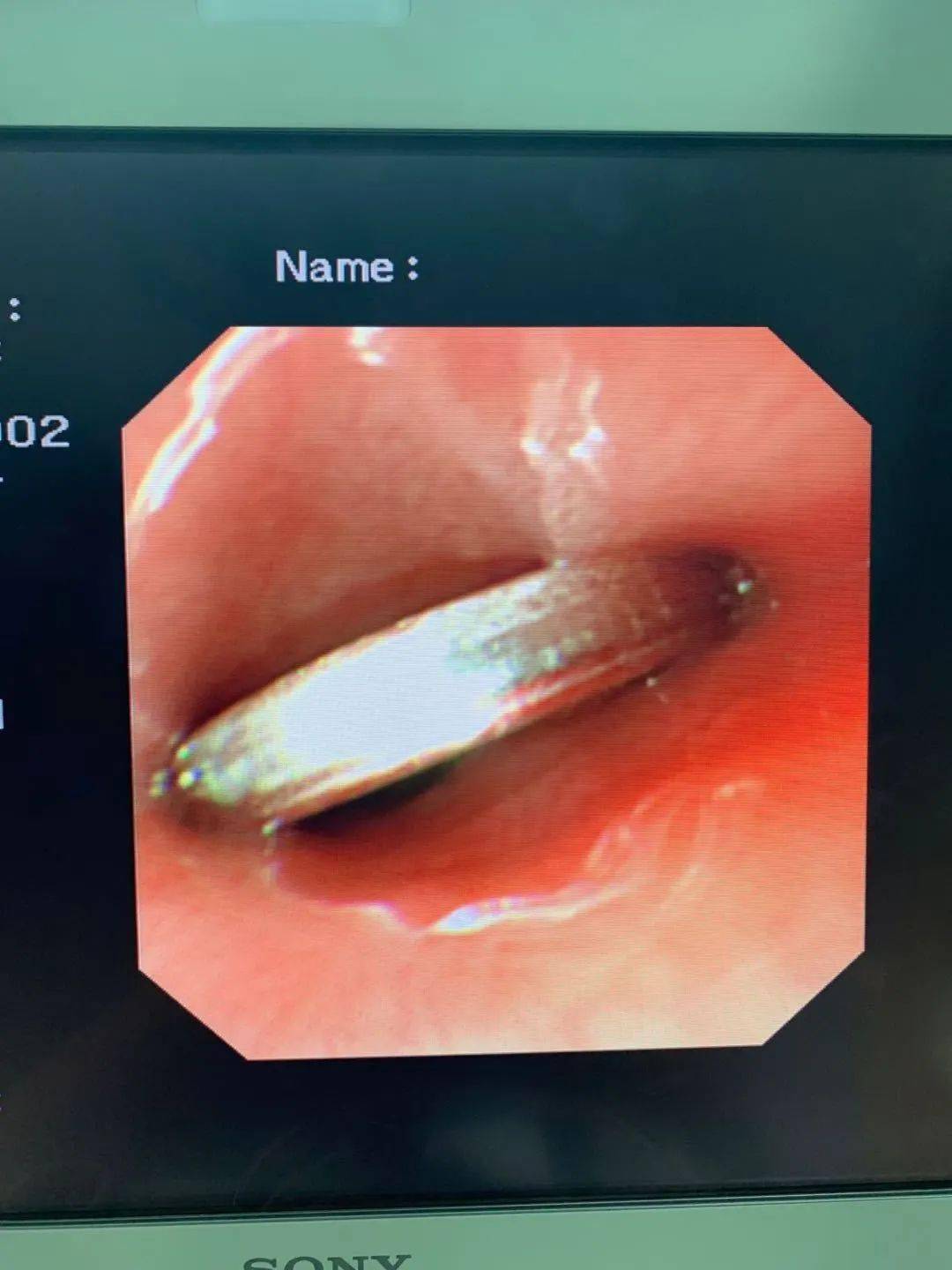 惊险淄博1岁儿童误吞硬币卡食管近20小时