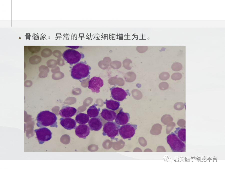 急性早幼粒细胞白血病