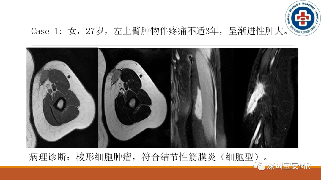 结节性筋膜炎临床与影像