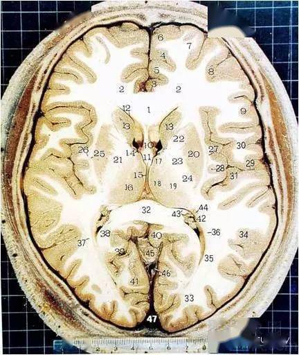 解剖| 經典顱腦斷層解剖圖——橫斷面_中央溝