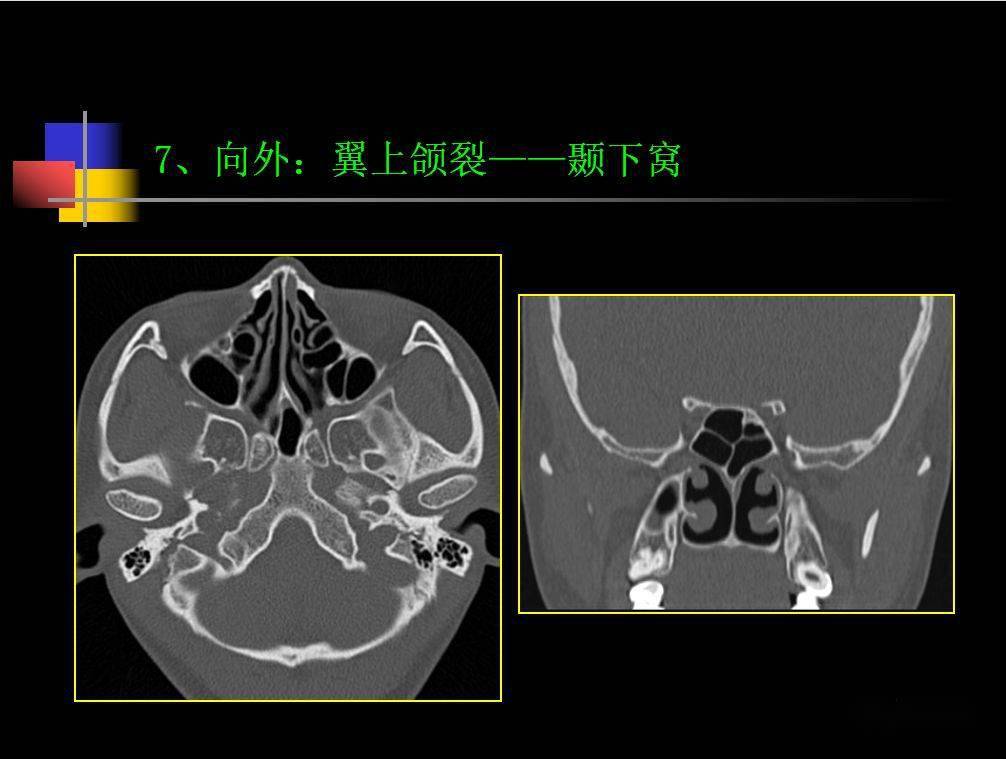 鼻咽腔CT图片