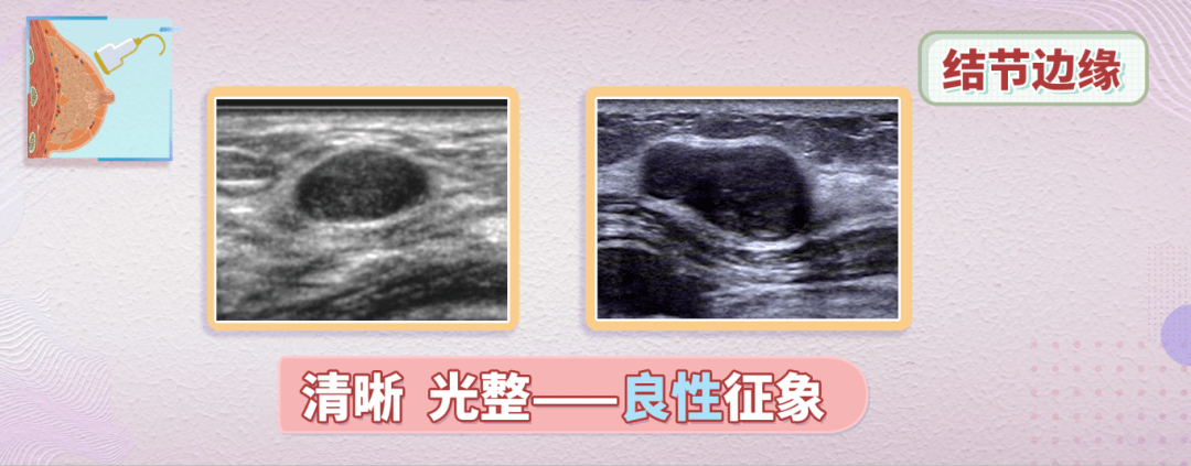 恶性的乳腺结节有这3种表现一旦发现千万别大意