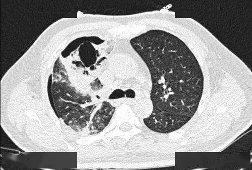 治疗急性脓胸,要釜底抽薪_患者