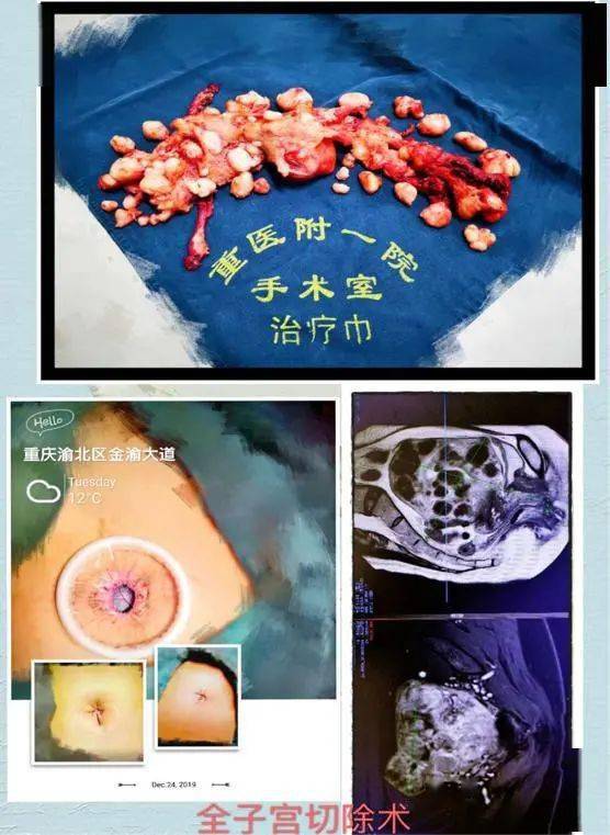 完美主义的践行者------单孔腹腔镜_手术