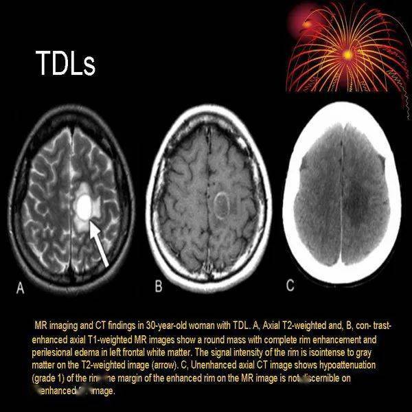 腫瘤樣脫髓鞘病變影像特徵以及鑑別診斷
