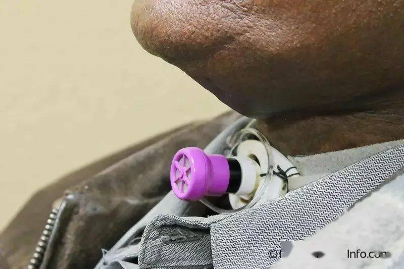 【吞咽小课堂】气切病人语言阀——说话瓣膜