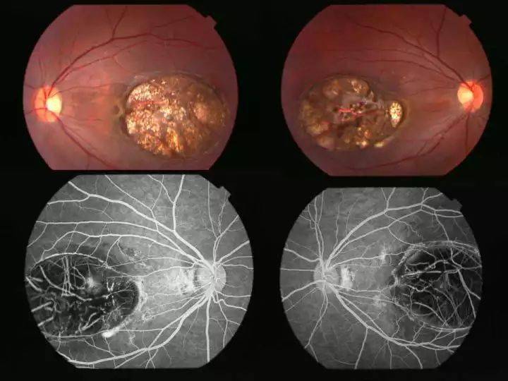 正常眼底荧光造影图片图片