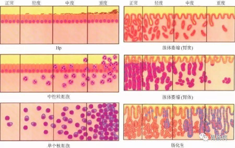 炎症—化生—萎缩—异型增生;按照组织学变化,慢性浅表性胃炎到慢性