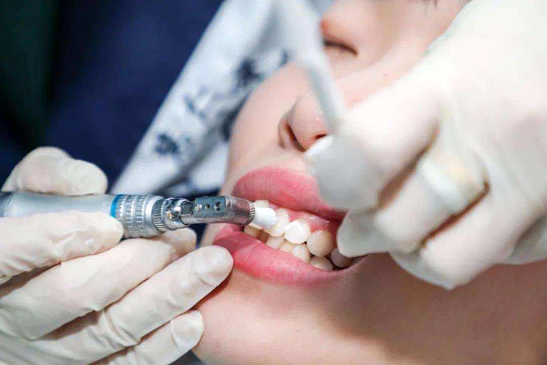 会遗 留下肉眼难以辨别的 小牙结石,还会有轻微划痕所以要给牙齿抛光!