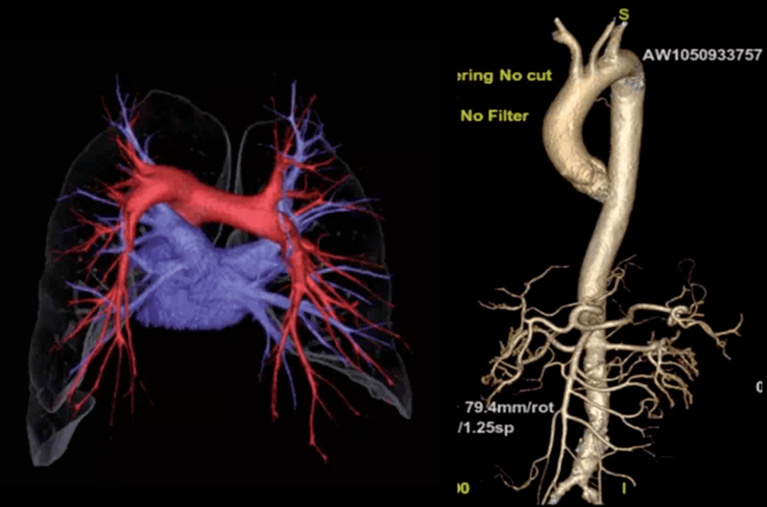 肺部CT图的血管分布图图片