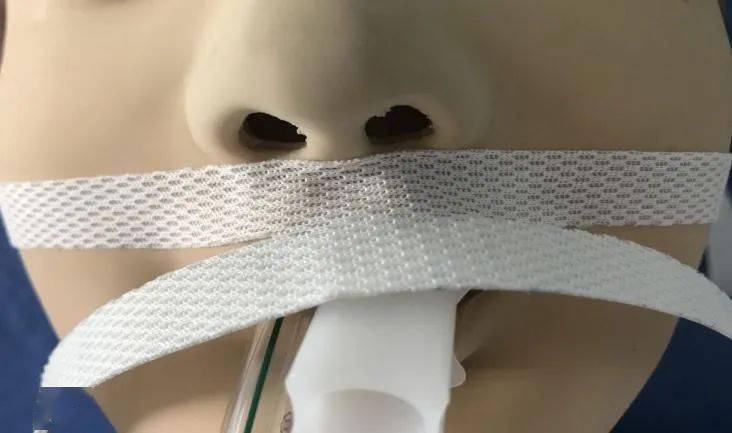 h型气管插管固定流程