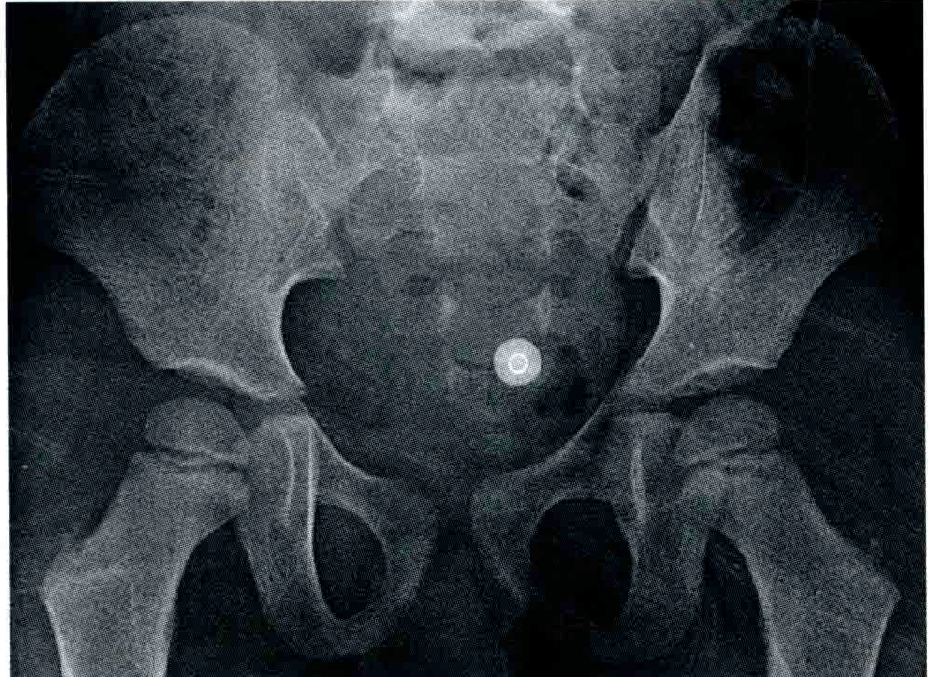 儿童骨盆平片图片