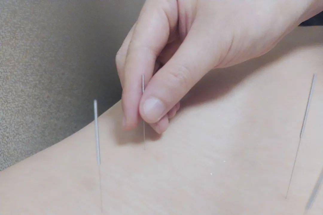 90后的第一次针灸,竟然爽出了猪叫声?