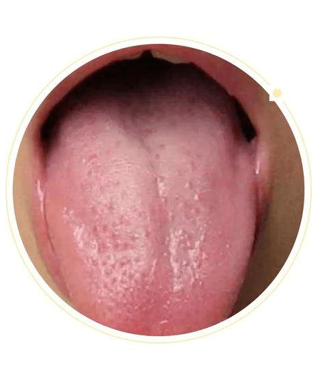 游走性舌炎图片图片