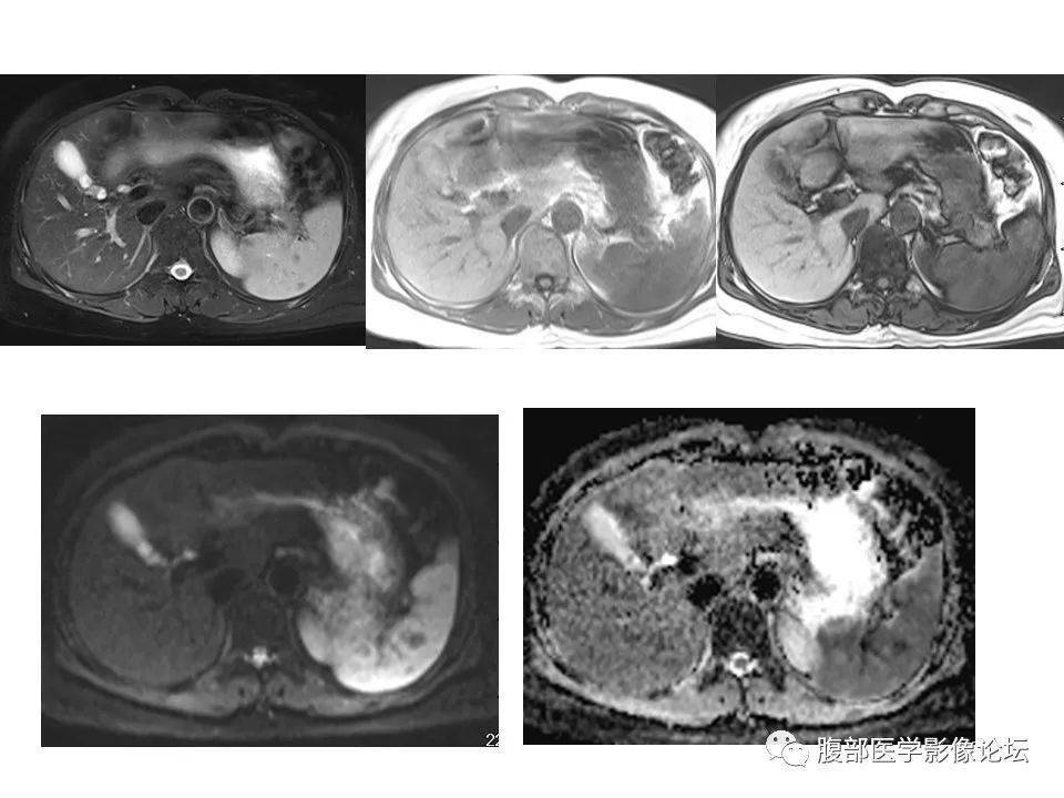 脾脏丨弥漫性大b细胞淋巴瘤(两例)