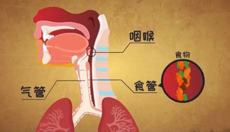 食物进入气管图片