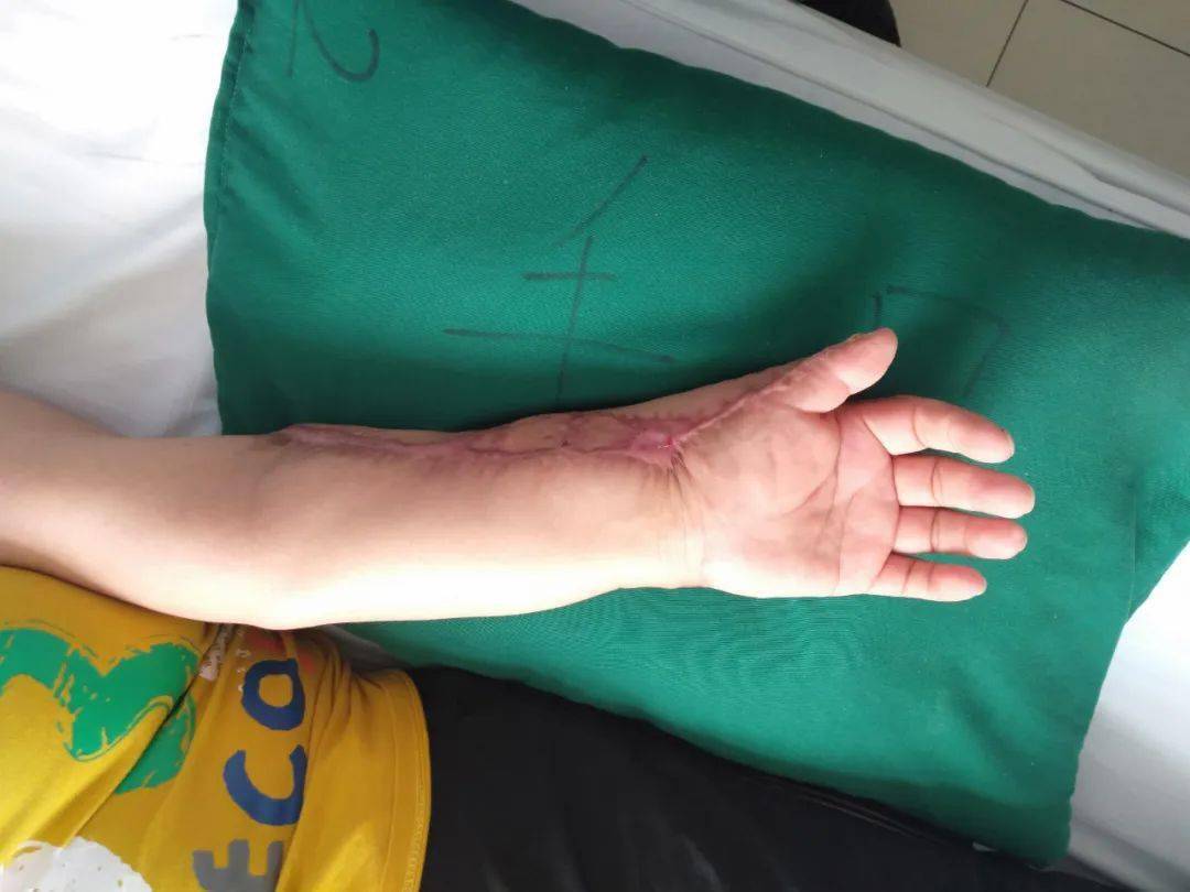 巴彦淖尔一女子胳膊被机器绞伤伤势严重万幸的是