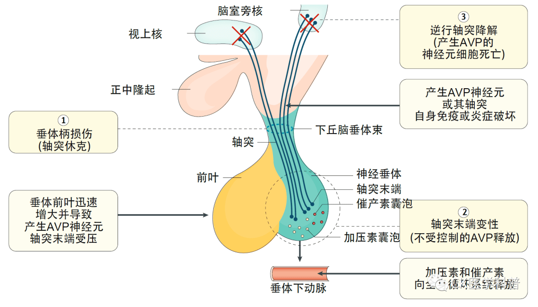 什么是尿崩症 来自搜狐网