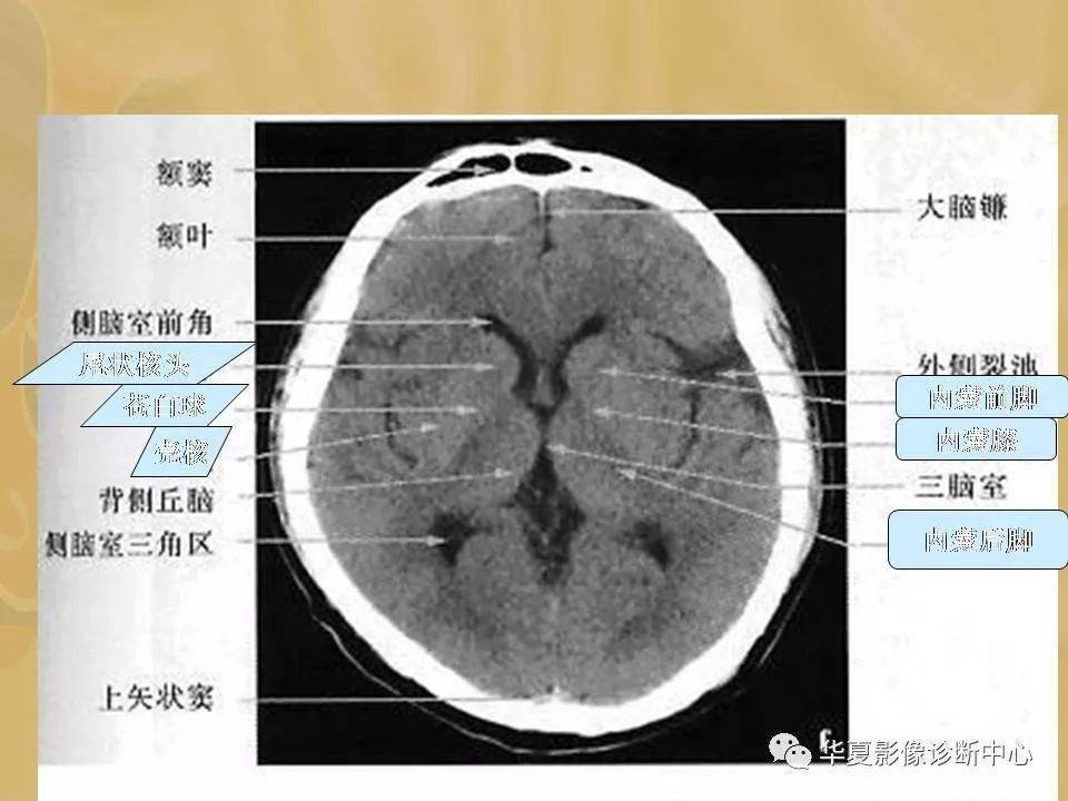 基底节解剖示意图图片