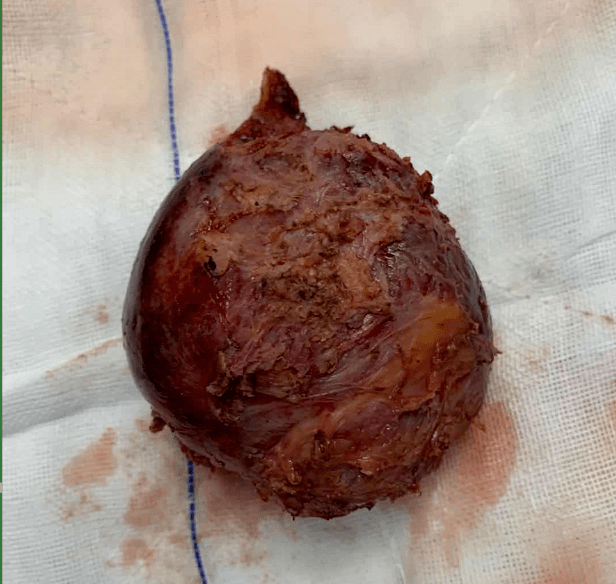 【三院·医疗现场】我院普外科为一名"熊猫血"患者成功切除肿瘤