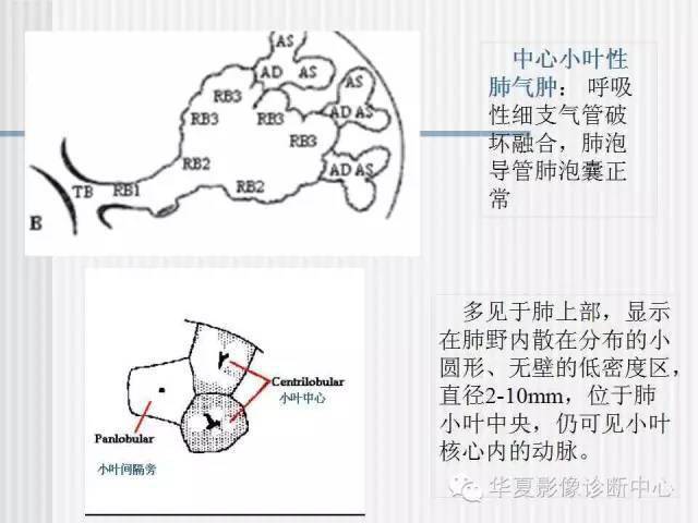 天天说的肺气肿分型是怎么分的呢