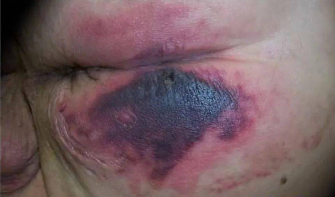 视频如何用水果学习压力性损伤分期