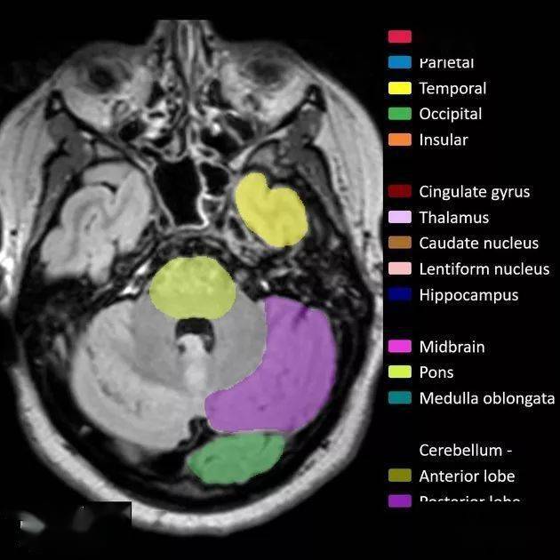 解剖丨腦葉分佈mri圖像彩色標註
