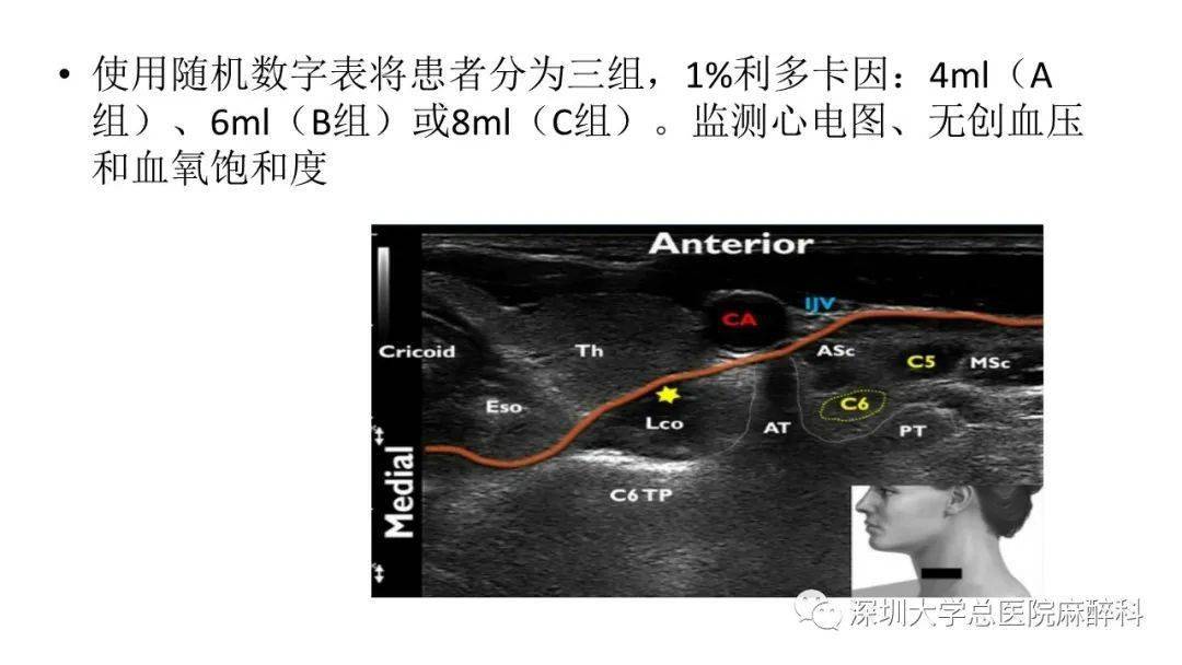 星状神经节阻滞超声图图片