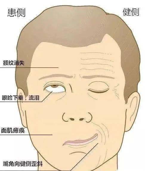 【健康宅家】李永凱:面癱患者居家康復方法