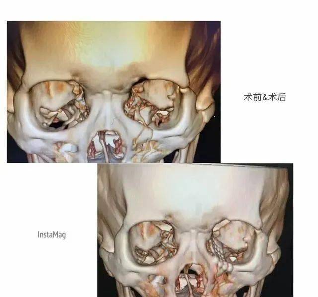 外傷後,上頜骨支柱部分裂開,但沒有張口和咬合的問題,於是李蓓博士