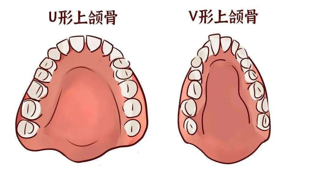 舌头位置也会受气流影响而下降,面颊部肌肉压迫牙弓,影响牙弓正常发育