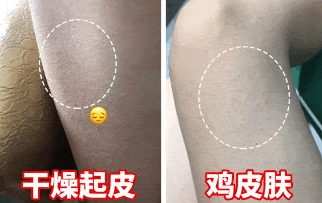 皮肤起鸡皮是什么病(鸡皮肤是什么病引起的)