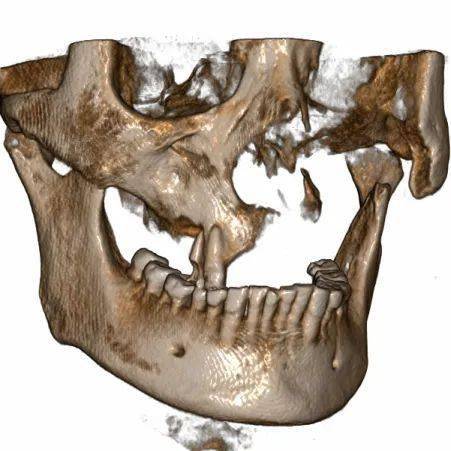 口腔科门诊完成一例单侧颌骨完全缺失复杂种植修复病例