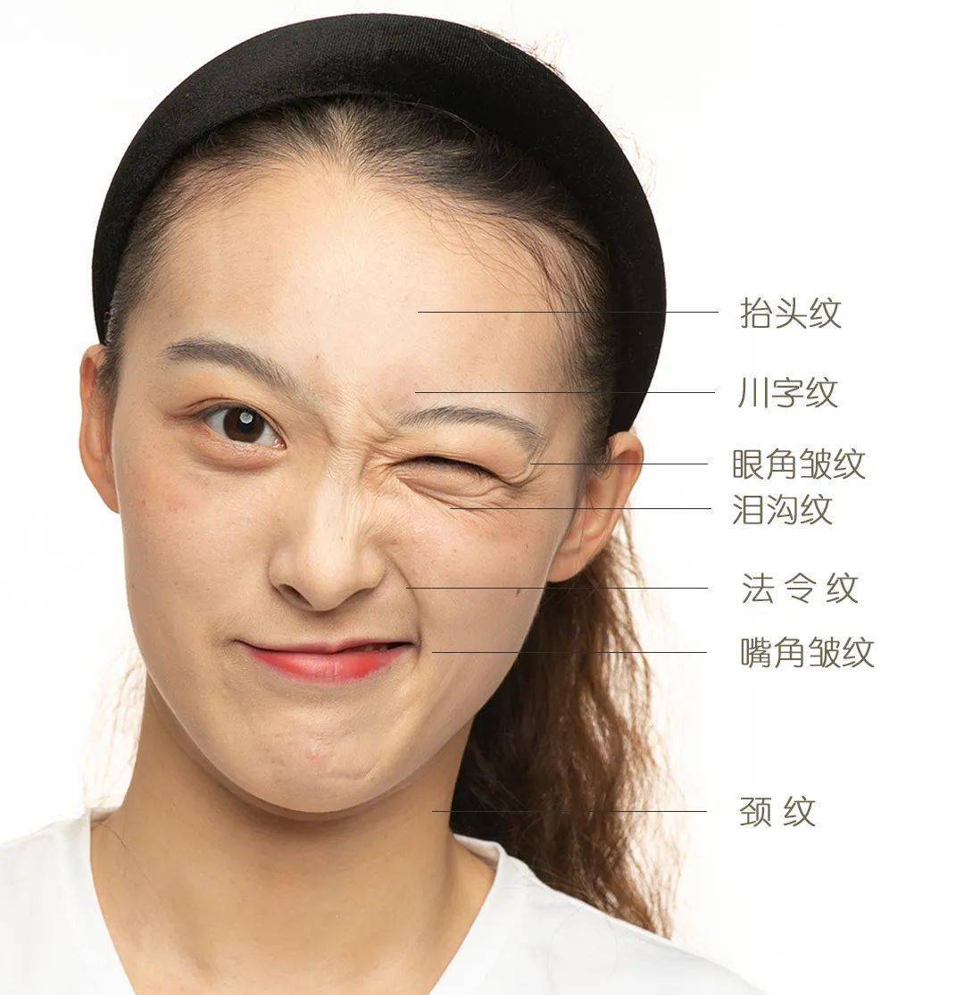 关于表情纹,其实是一种由于皮肤长期被拉扯,肌肉运动导致皮肤记忆所