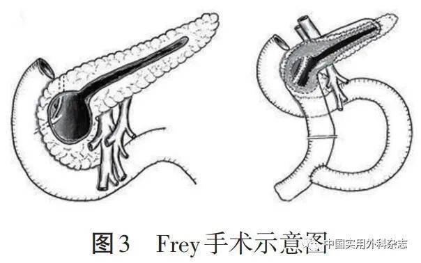 frey手术图片