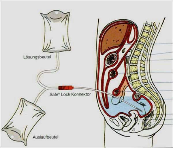 腹腔引流管图片 原理图片