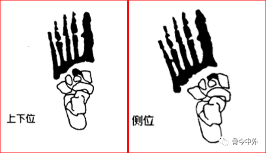 解读关于lisfranc损伤的4个知识点!