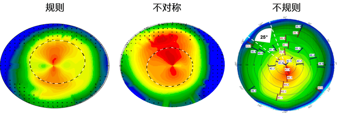 地形图引导的个性化适应症的扩充77角膜疤痕77不规则切削77小光
