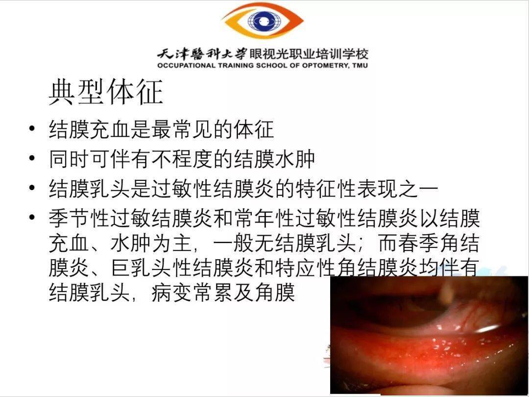 【眼视光】 过敏性结膜炎-搜狐大视野-搜狐新闻