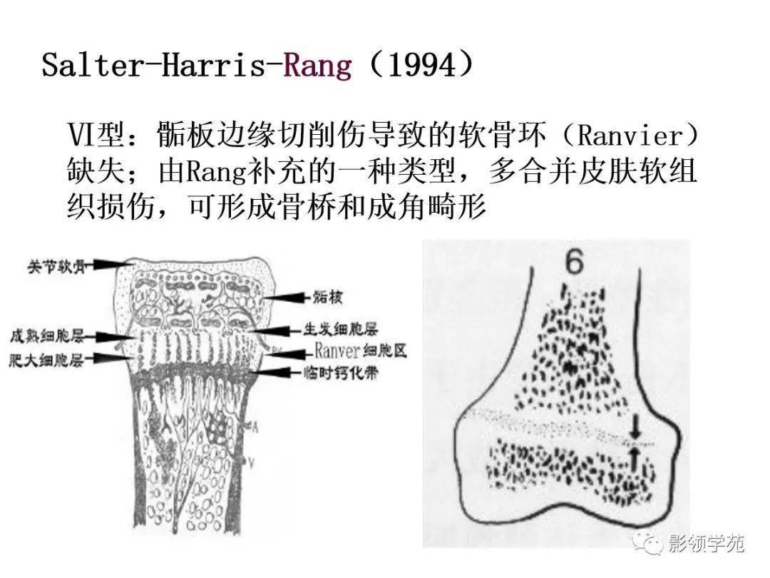 远端全骺分离指肱骨远端包括全部骨骺的软骨块和干骺端之间的分离错位