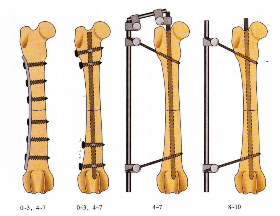 股骨骨干骨折(髓内针的应用)