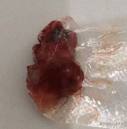 肺癌咳出肿瘤组织图片图片