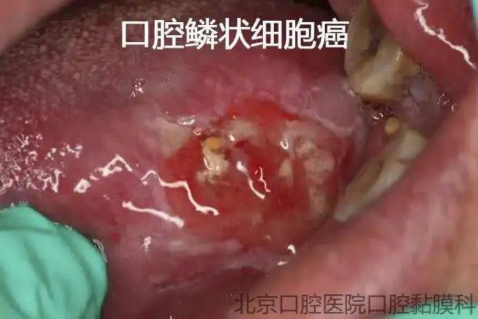 病理结果显示左舌根的溃疡已经发展为"口腔鳞状细胞癌",也就是俗称的