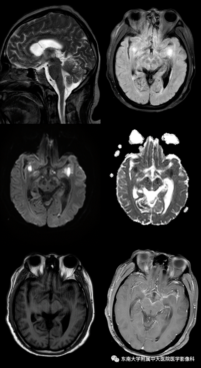 病史 男,44岁,因"头痛20余天,发热13天"入院 mr 平扫 增强