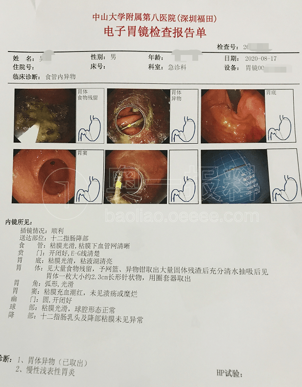 奥一君从吴先生提供的电子胃镜检查报告单中看到,吴先生的胃部有一根
