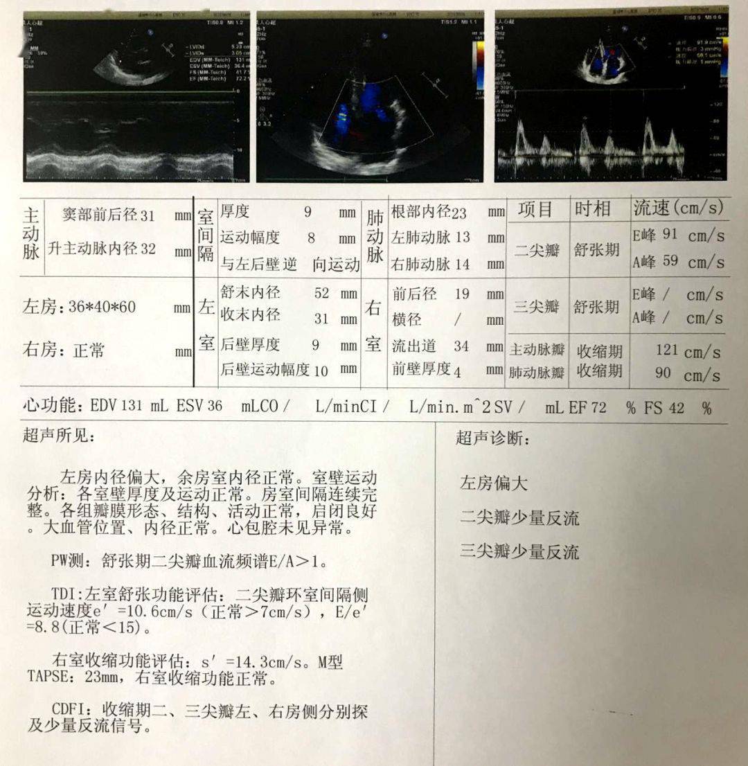 我院心内一科开展我市首例心腔内超声ice指导下房颤射频消融手术