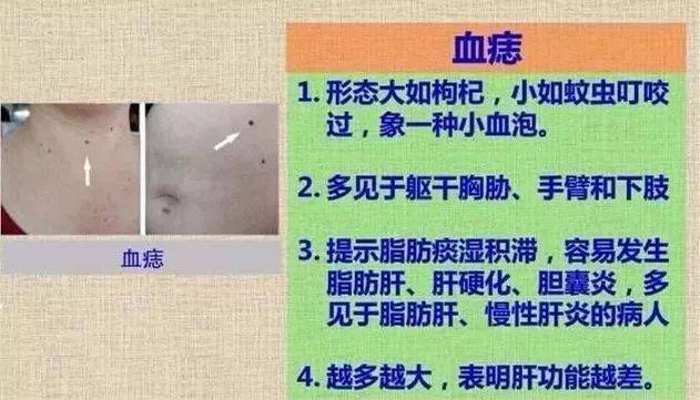 血管痣是什么原因引起图片