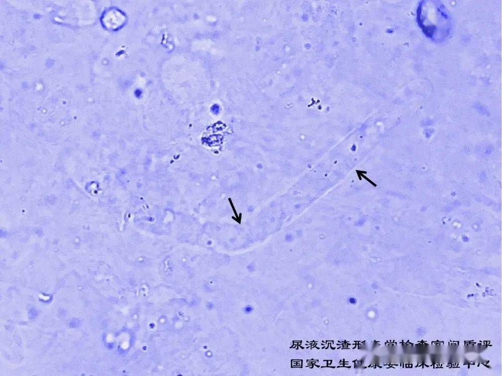 2020年尿液沉渣形态学检查室间质量评价