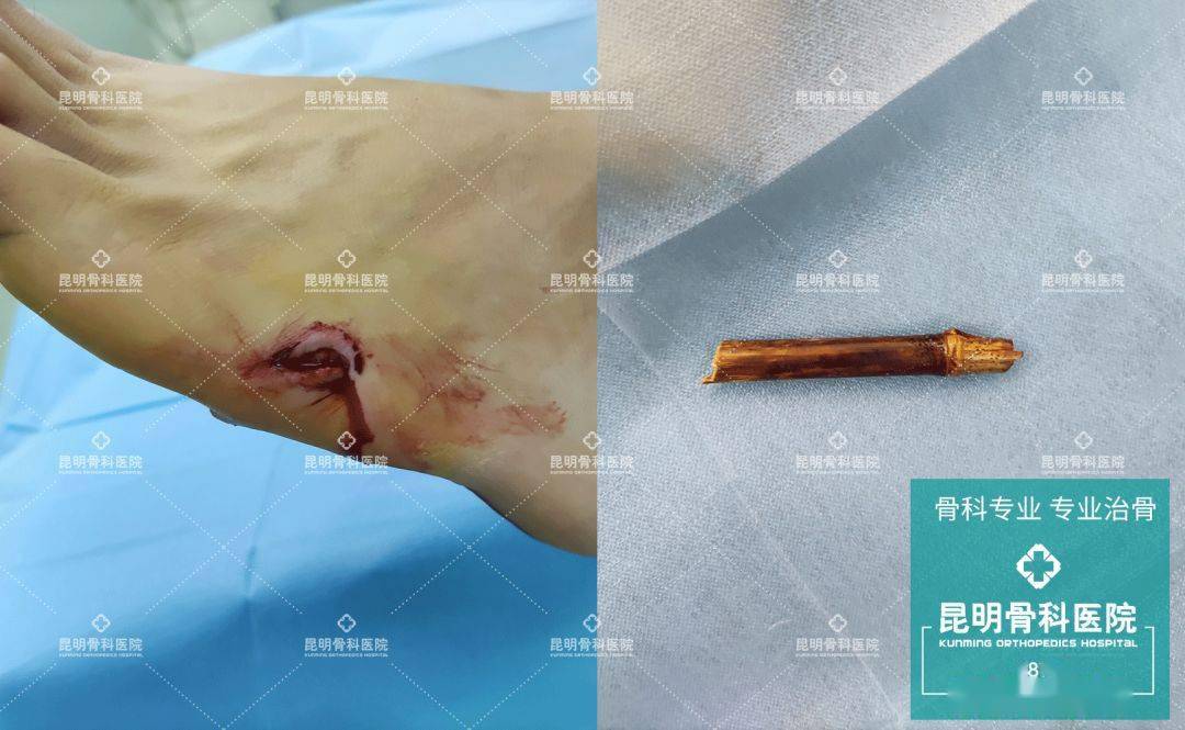 竹子刺穿脚钥匙插入头医生提醒异物插入身体不要随便拔出