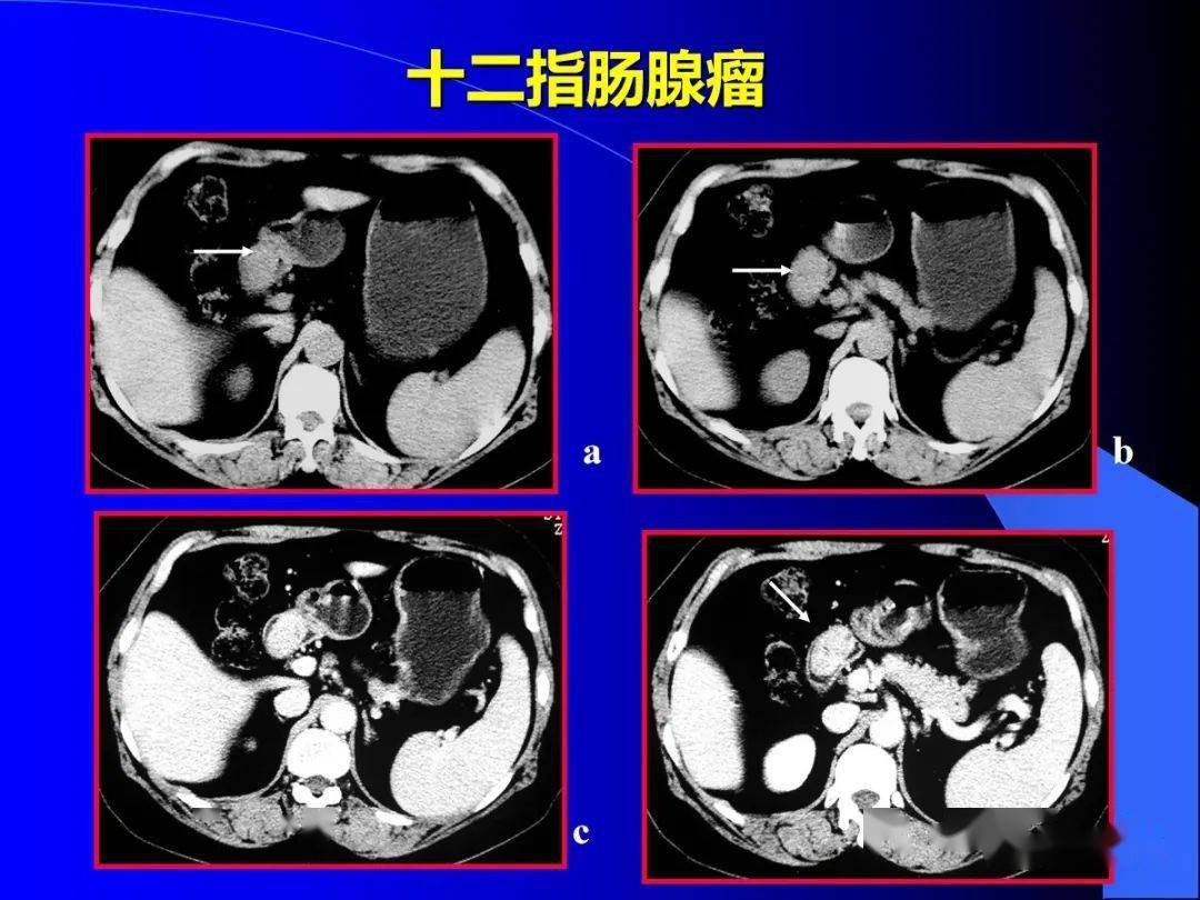 小肠良恶性肿瘤的ct诊断